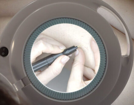 Behandlung-Besenreiser-phlebolyse